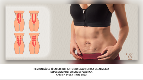 O Que Di Stase Abdominal Quais S O Os Sintomas E Como Tratar Dr Esa