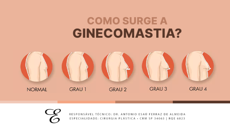 Como surge a ginecomastia e como tratá-la? - Dr. Esaú
